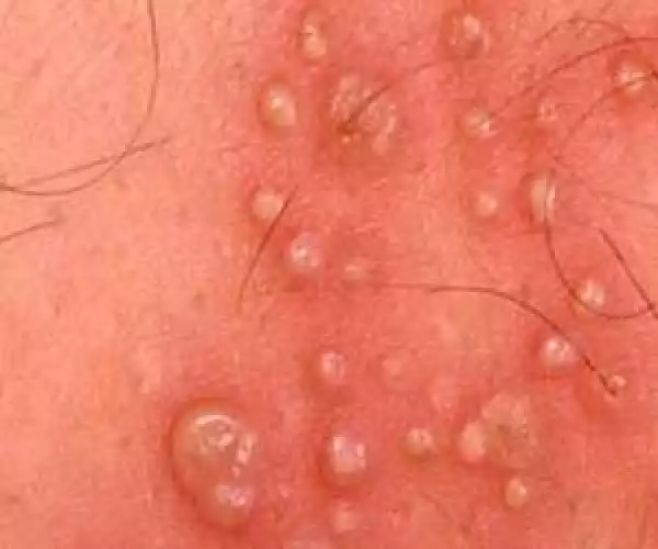 Vaginal Heat Rash Is The Deadly Disease Ladies Can Have…It Kills In Less Than 6 Hours. See Images, Symptoms, Location, And Treatment